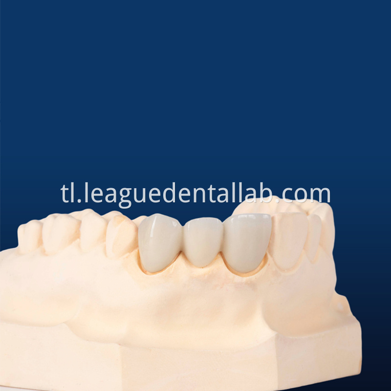 PFM,Metal crown,Fixed metal crown